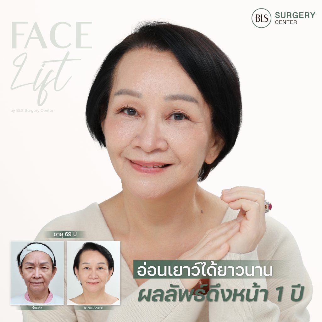 ดึงหน้า ดึงคอ ครบ 1 ปี ผลลัพธ์ธรรมชาติ
