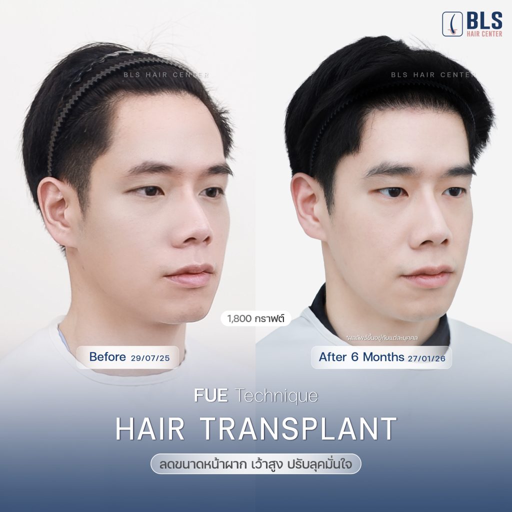 รีวิวปลูกผม FUE