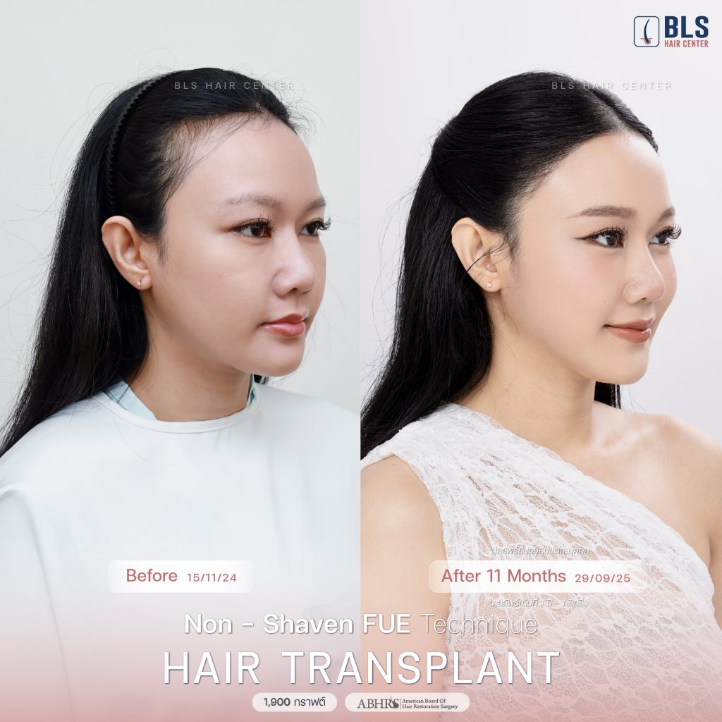  รีวิวปลูกผมยาว Long Hair