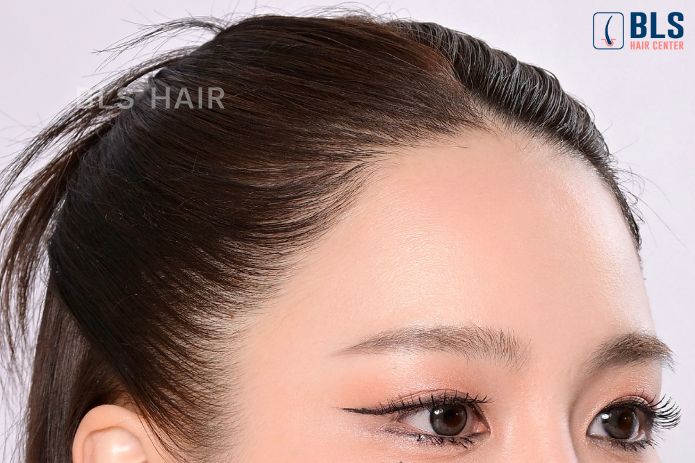 แนวผมธรรมชาติ BLS Hairline