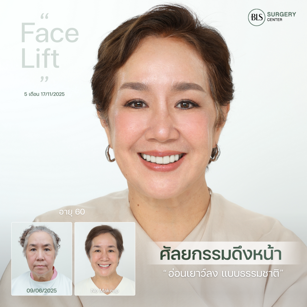 แม่เขื่อน ดนัย K-OTIC ศัลยกรรมดึงหน้า ดึงคอ ที่ BLS
